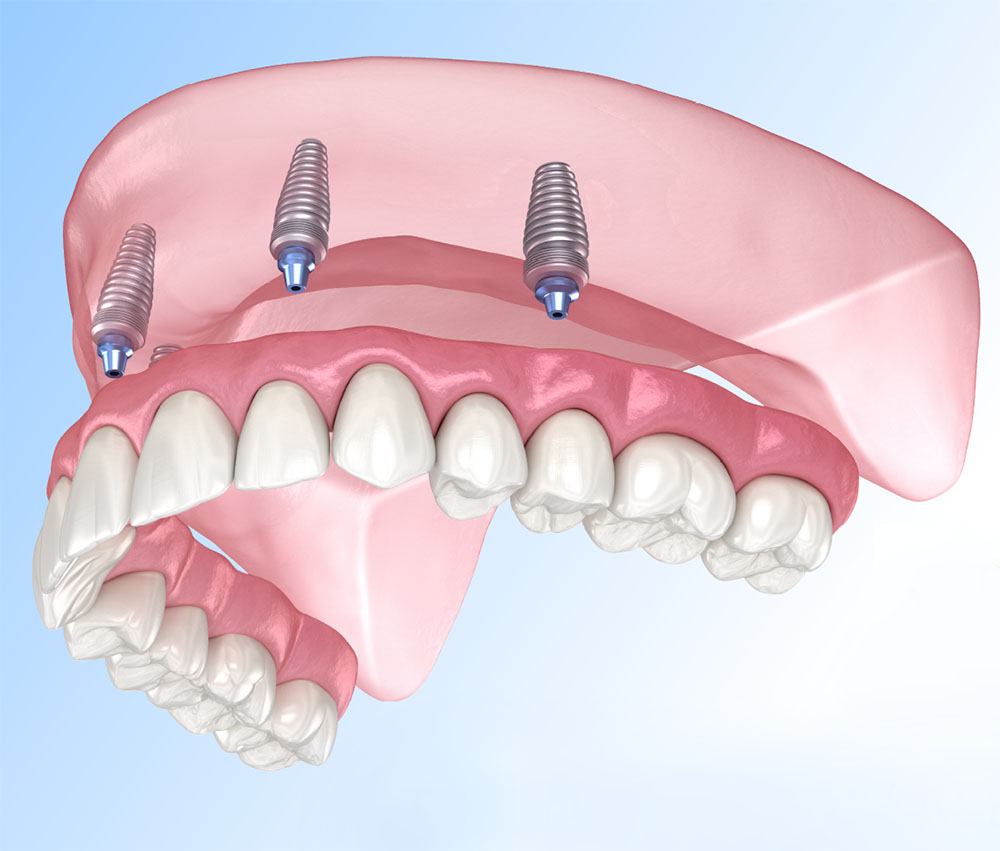 3D illustration of an All-on-4 full-arch restoration supported by four dental implants