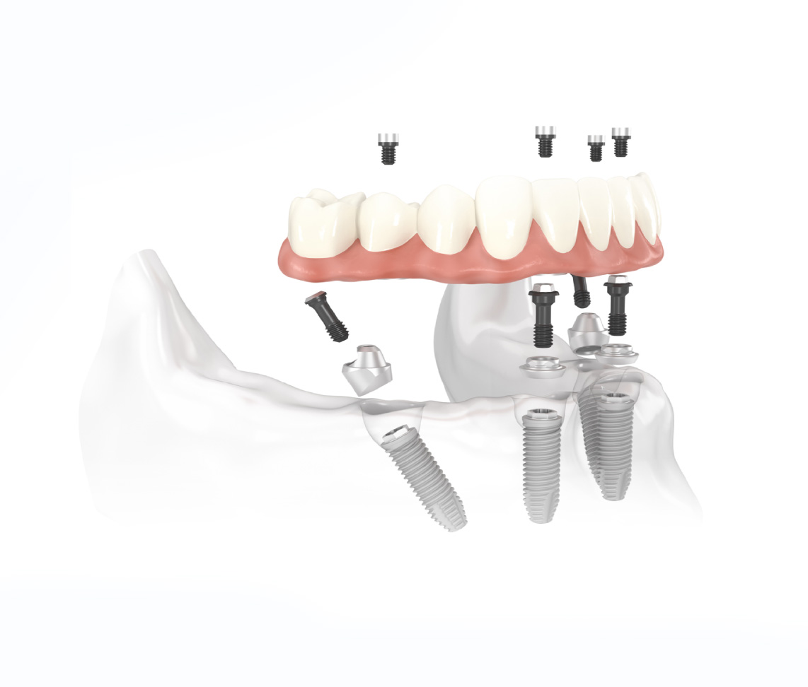 Exploded view of the All-on-X implant bridge, abutments and implants