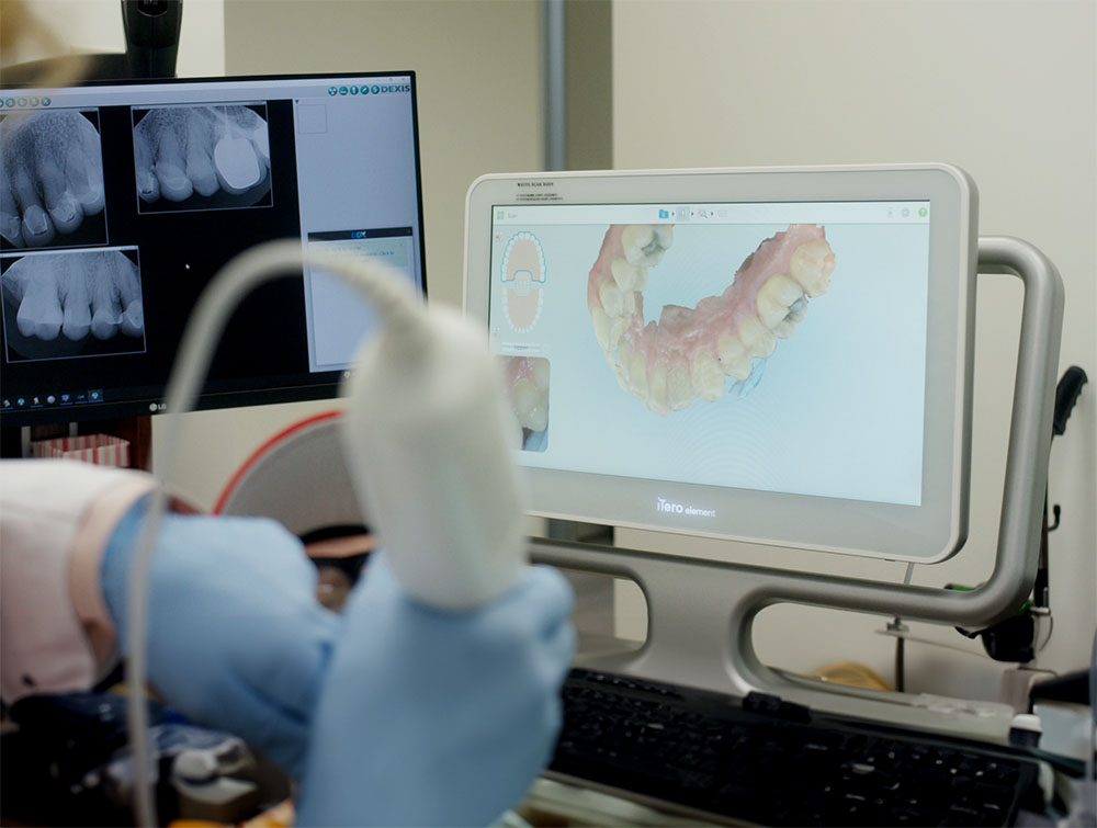 Digital intraoral 3D scan on an iTero scanner